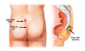 Pilonidal Sinus Treatment